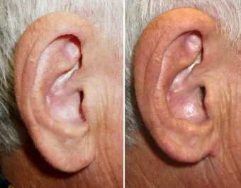 earlobe reduction in richmond