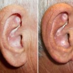 earlobe reduction in richmond