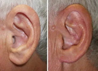 earlobe reduction in richmond