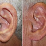 earlobe reduction in richmond