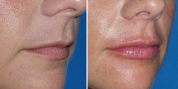 Before and after lip filler
