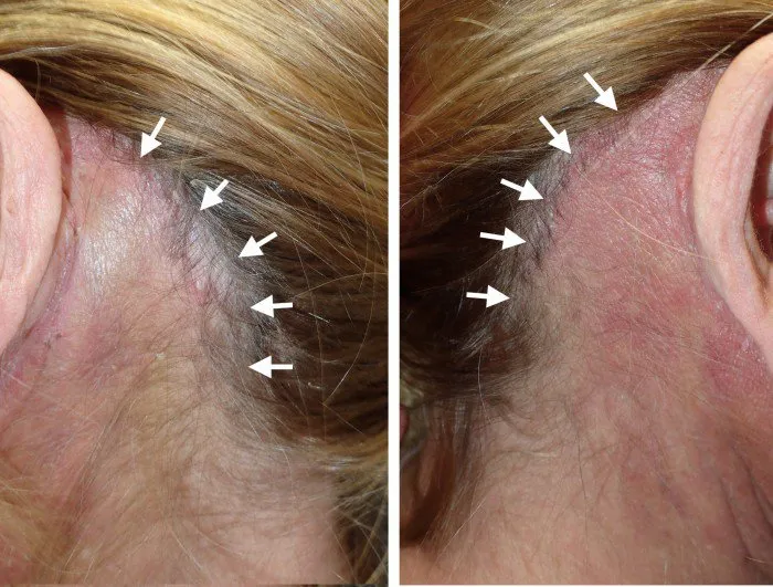 facelift incision gently follows the hairline usually results in an imperceptible scar