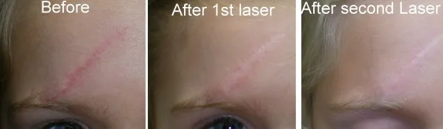 facial scar surgery in richmond