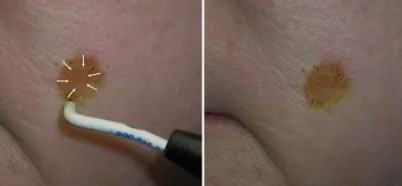 Mole Removal in Richmond, VA
