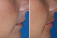Before and after lip enhancement