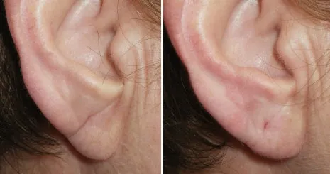 earlobe reduction in richmond, VA