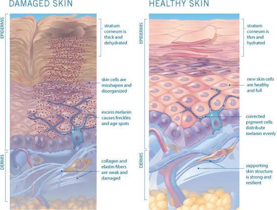 Chart showing the differences between damaged skin and healthy skin, Richmond VA. How Skin Ages