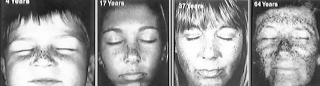 Skin scans showing sun damage at 4, 17, 37, and 64.