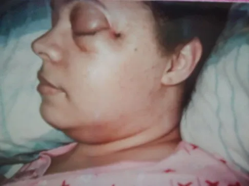 Recovering from bullet wound facial injury