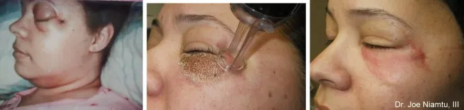 before and after laser treatment to lessen the effects of the scarring
