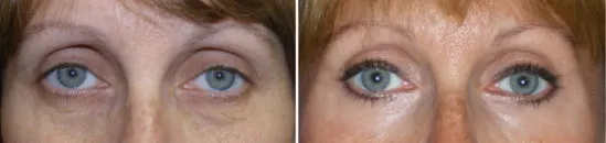 Face Peels in Richmond, VA
