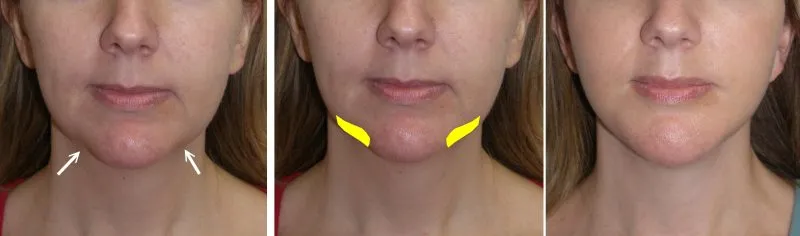 upclose photo of a chin