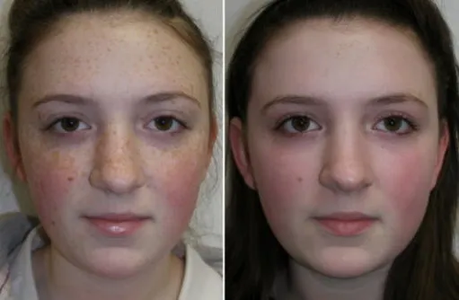 Face Peels in Richmond