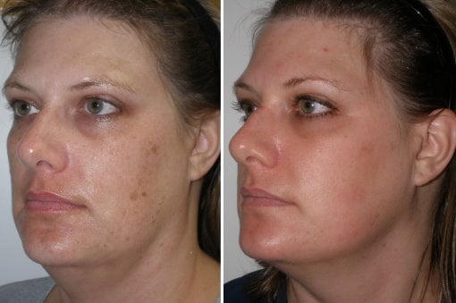 Before and After Active FX Laser