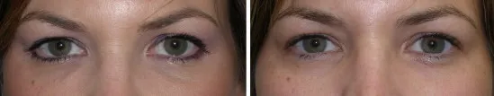 upper face filler in richmond