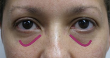 upper face filler in richmond