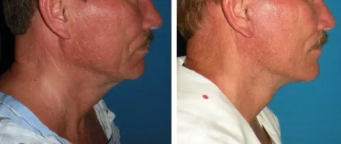 Facelifts for Men in Richmond