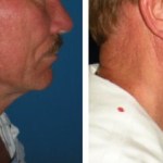 Facelifts for Men in Richmond