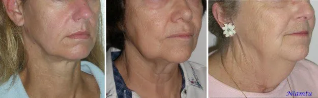 types-of-facelifts