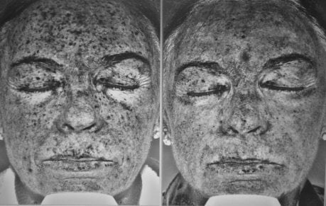 ultraviolet photography before and after laser resurfacing treatment