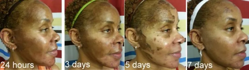 face peels