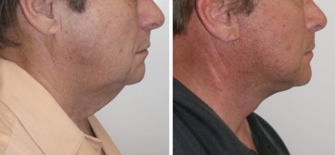 Facelifts for Men in Richmond