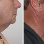 Facelifts for Men in Richmond