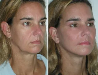 This female patient underwent mini-facelift, upper eyelid surgery and submalar implants. Although there is improvement from all procedures, it is the cheek implants that truly make her look younger.
