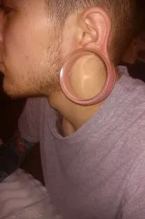 gauged earlobe repair