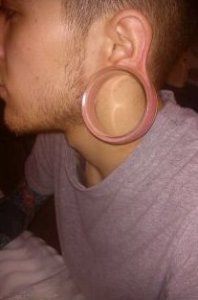 gauged earlobe repair