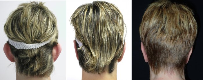 before surgery (left image), 6 months after surgery (middle image) and 13 years after surgery (right image)