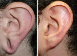 gauged earlobe repair