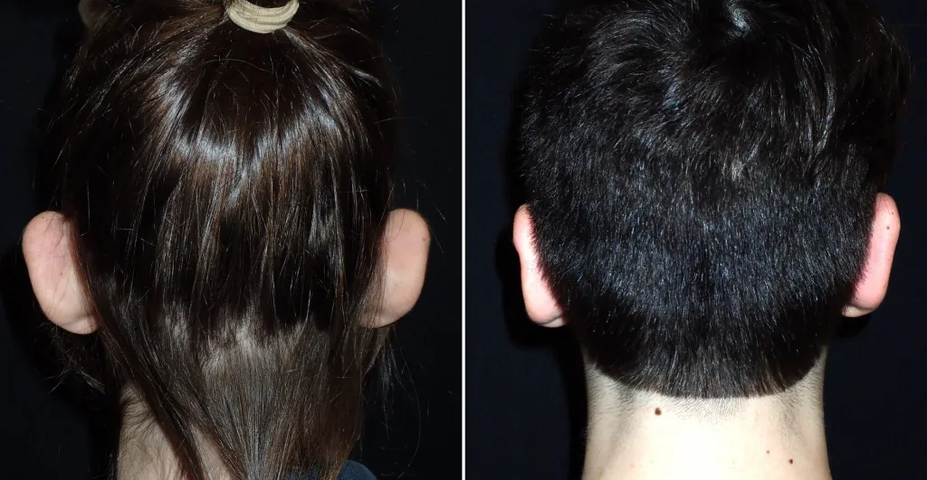 patient with long hairstyle to hide protruding ears. Commonly for post op appointment, patients return with with short hair, often for the first time in their lives