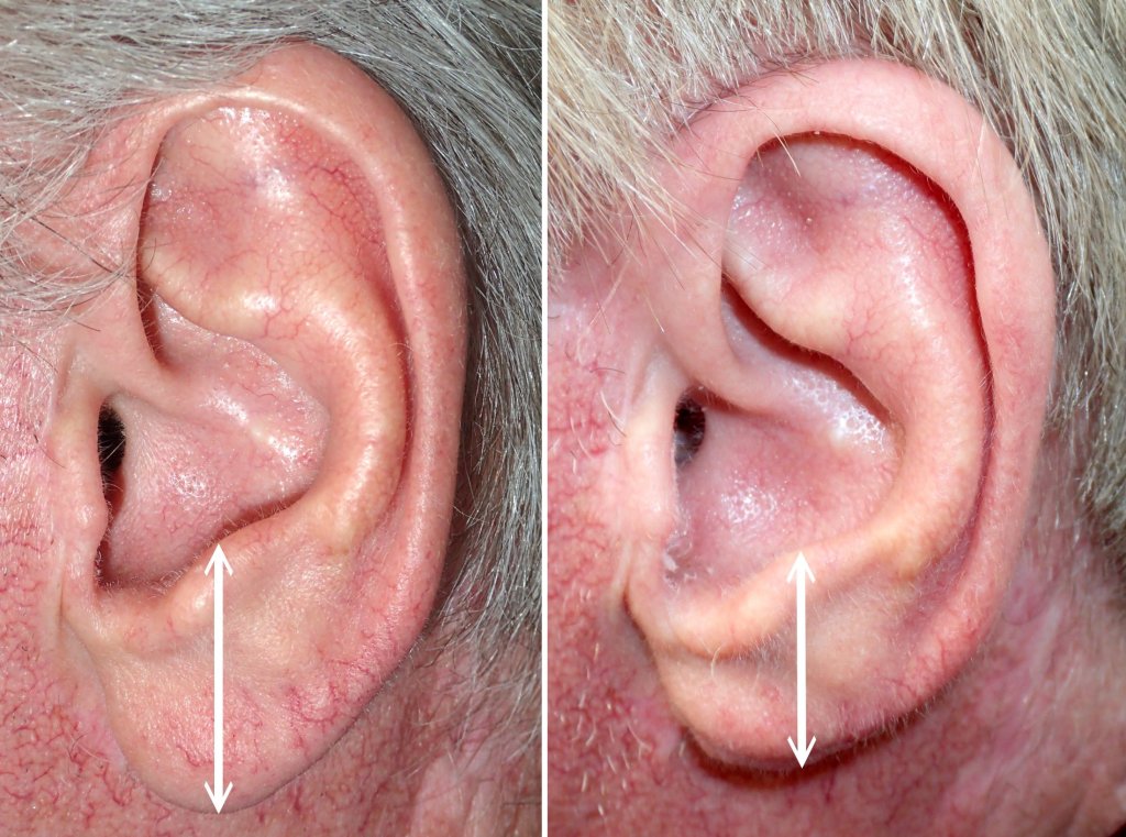 earlobe reduction in richmond