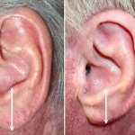 earlobe reduction in richmond