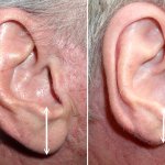 earlobe reduction