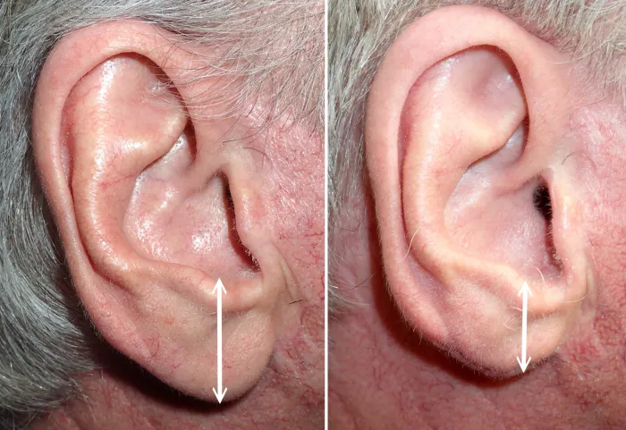 earlobe reduction in richmond