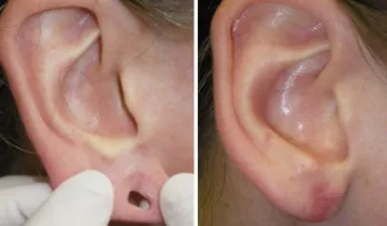gauged earlobe repair