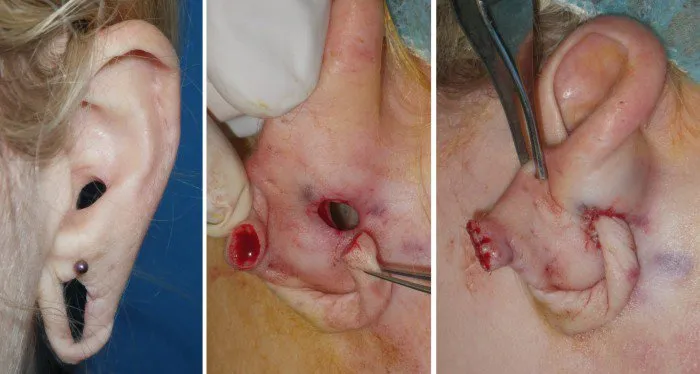gauged-earlobe-repair-case-1a