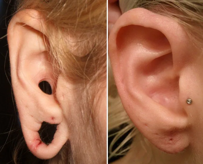 gauged-earlobe-repair-case-1b