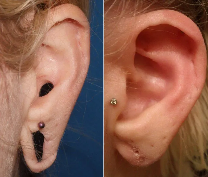 gauged-earlobe-repair-case-1c