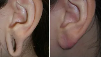 gauged earlobe repair