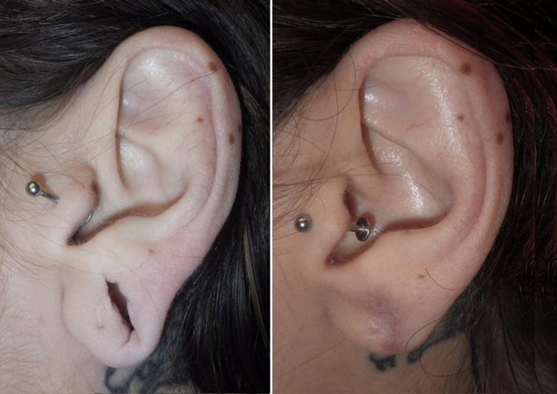 Gauged Earlobe Repair Richmond VA Repair Earlobe Midlothian
