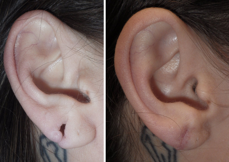 gauged earlobe repair in richmond