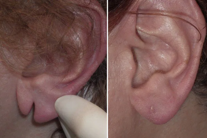 torn-earlobe-repair