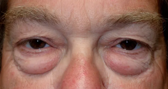this patient shows severe upper and lower lid aging