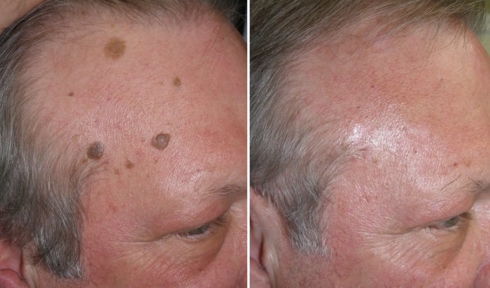 Before and after mole removal, photos of male patient