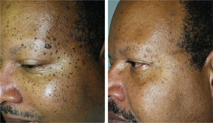 Before and after mole removal, photos of male patient