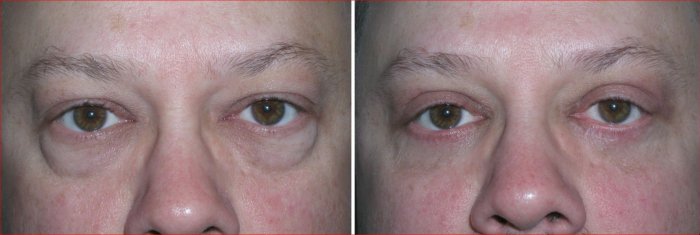 Eyelid Surgery for Men in Richmond