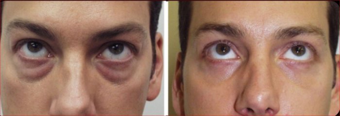 Eyelid Surgery for Men in Richmond